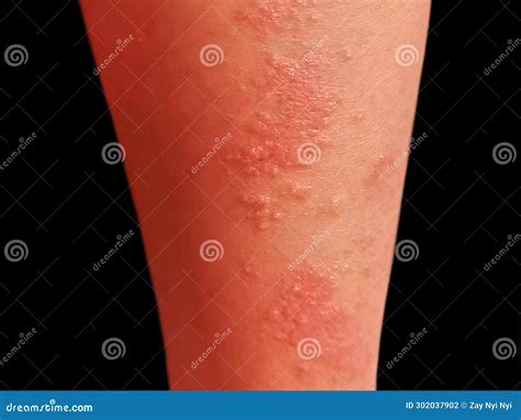 Herpes Simplex On Legs