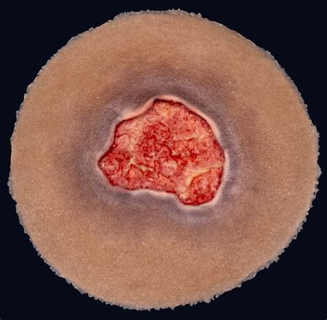 Stage 3 Pressure Injury – Techline Trauma