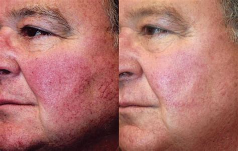 Best Laser For Rosacea Flushing at Pauline Dane blog