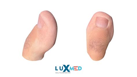 Prosthetic Toes: Features & Costs » Luxmed Prosthetic