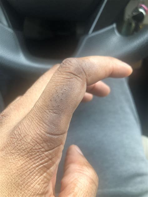Weird black spots on finger : r/SkincareAddicts