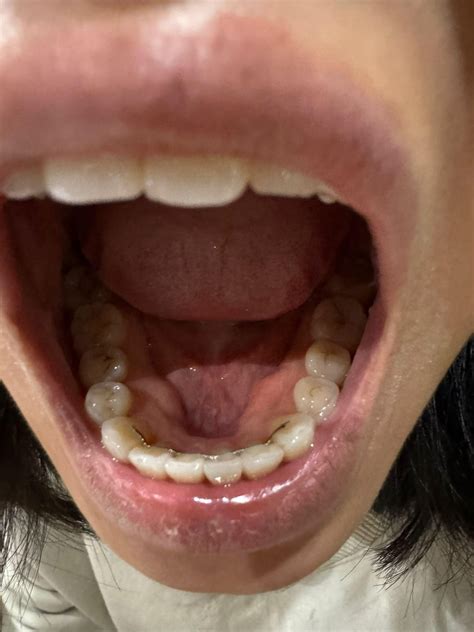 Mandibular tori removal and stitches post-Invisalign : r/Invisalign