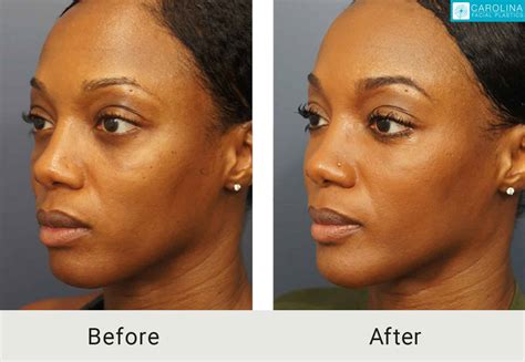 Face Fat Maker at Adolfo Scanlan blog