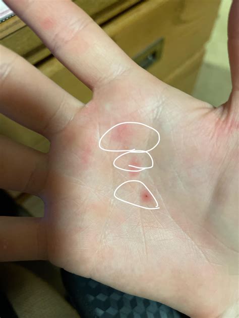 Itchy Hands Pregnancy