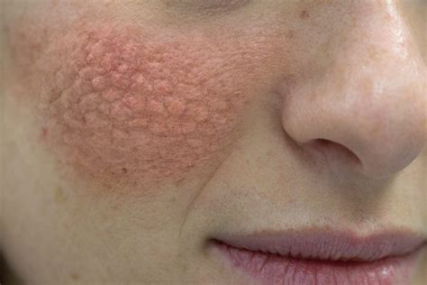 What Causes Lupus | Pompa Program