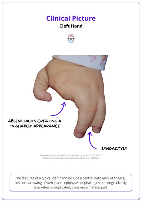 Cleft Hand