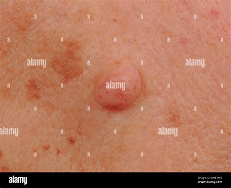 Intradermal hi-res stock photography and images - Alamy