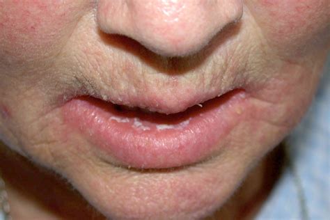 Oral Thrush Cheeks