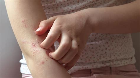 Is Eczema an Autoimmune Disease? - GoodRx