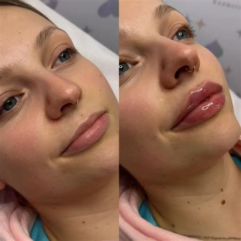 Lip Filler Before and After - Before After Journey