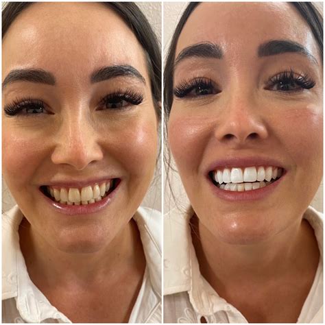 Teeth Whitening Special 209 NYC Dental Cosmetic Dentists - amtech.blog
