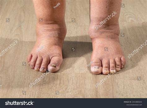 Edema In Feet