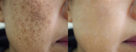 Laser Treatment for Sun Damage & Sun Spots | Skiin