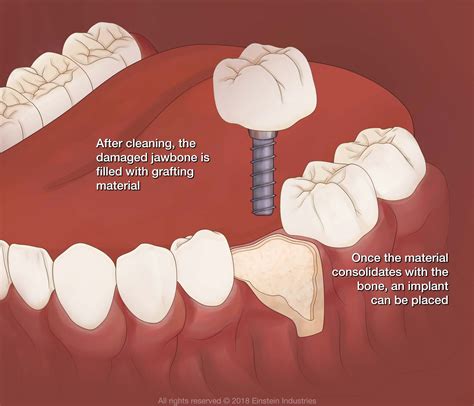 Types Of Dental Bone Graft Material at Isabel Spiegel blog