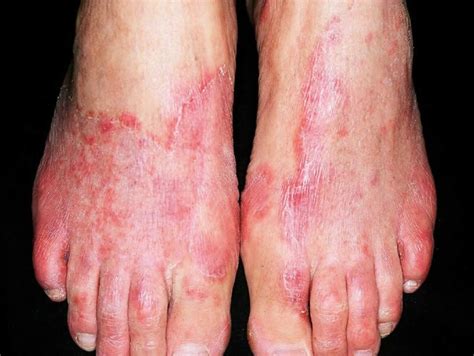 Tinea pedis, athlete's foot, causes, symptoms, diagnosis & treatment