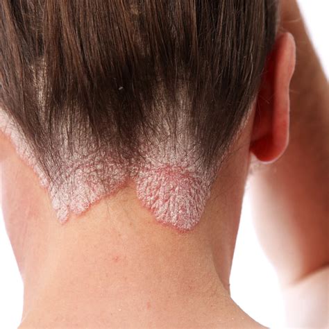 Psoriasis and Hair Loss: Hair Treatments - Nottingham & London