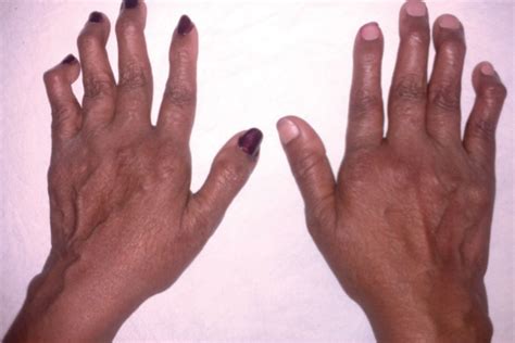 Rheumatoid Arthritis Thumb