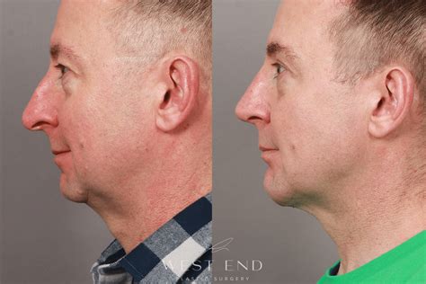 Jaw Implants Before And After