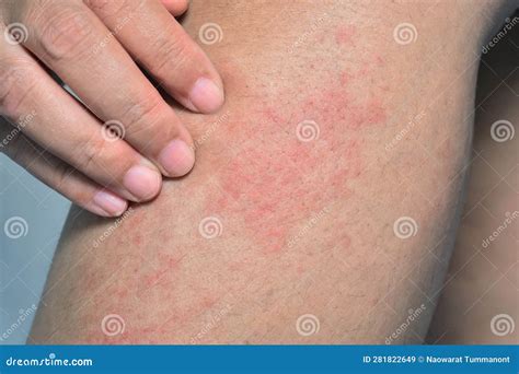 Skin Rashes On Legs