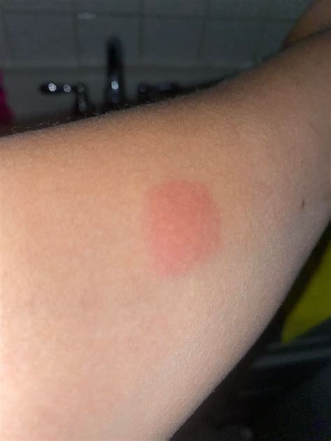 Does this look positive.? : r/Tuberculosis