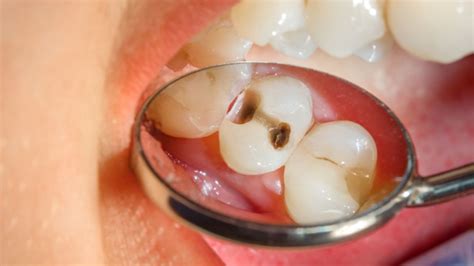 Black Stains On Teeth: Causes and Treatment in Bassendean