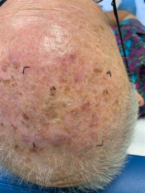 Actinic Keratosis Pictures Before After Pictures Of Actinic Keratosis,