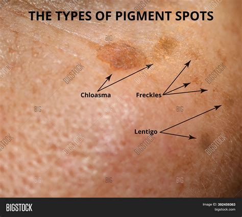 Brown Spots On Your Skin