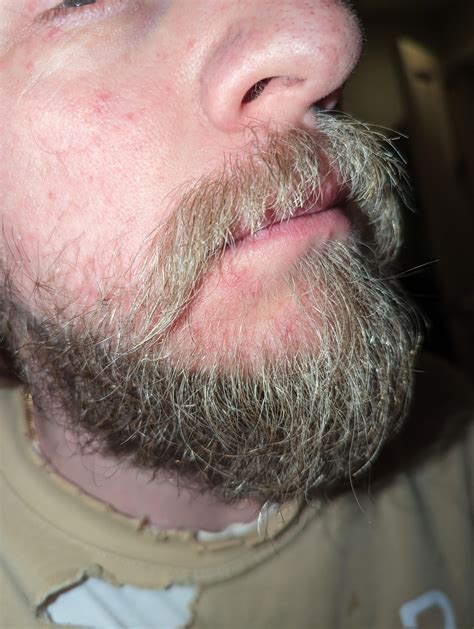 What to use for rash on chin? : r/DermatologyQuestions
