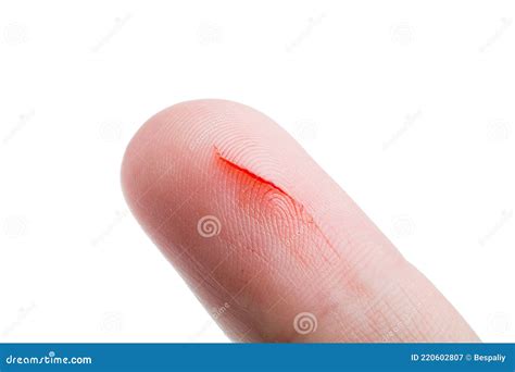 Human Finger with a Cut a Consequence of Skin Damage and Open Bleeding ...