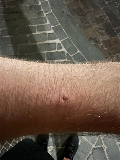 Should You Get A Tetanus Shot After A Dog Bite