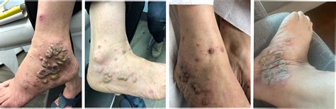 Treatment of hypertrophic lichen planus using deucravacitinib - JAAD Case Reports