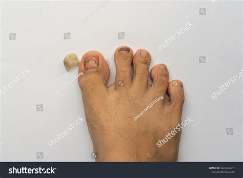 Toenail Falling Out