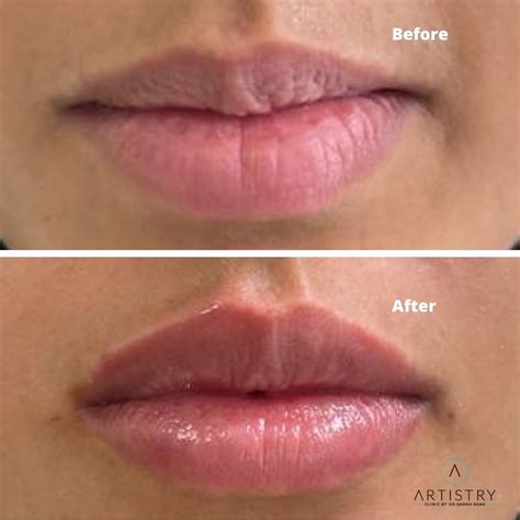 Lip Filler Before and After | Artistry Clinic