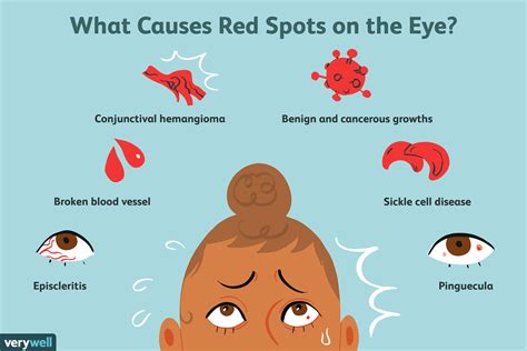 Possible Causes of a Red Spot on Your Eye