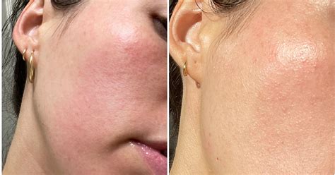 What Is Contact Dermatitis? Skin Tips From a Dermatologist | PS Beauty