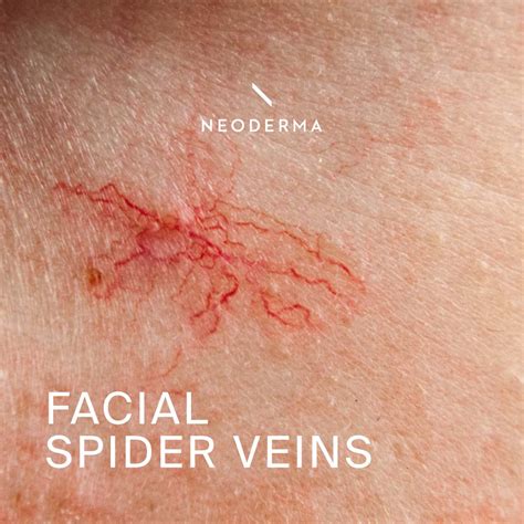Facial Spider Veins – NEODERMA