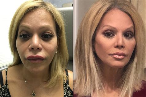 Bad Lip Injections Before And After