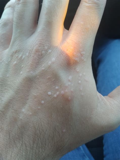 Any idea what these weird bumps on my hand are? They're not always this pronounced. : r ...