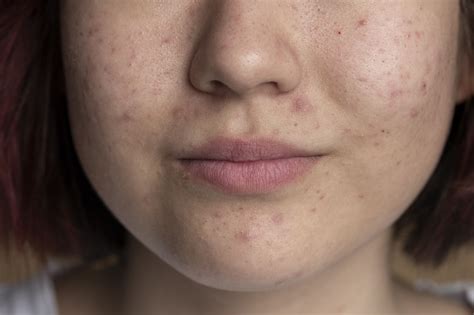 Korean Pore Minimizing Treatments: The Complete Guide From Surgery to ...