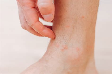 Causes of Red Skin on Legs Above Ankles
