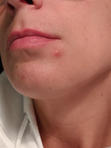 Warm Or Cold Compress For Zit at Kenneth Keene blog