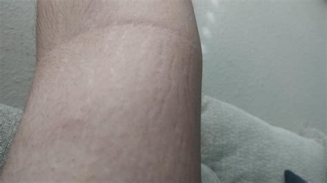 What are these lines on my arm? : r/DiagnoseMe