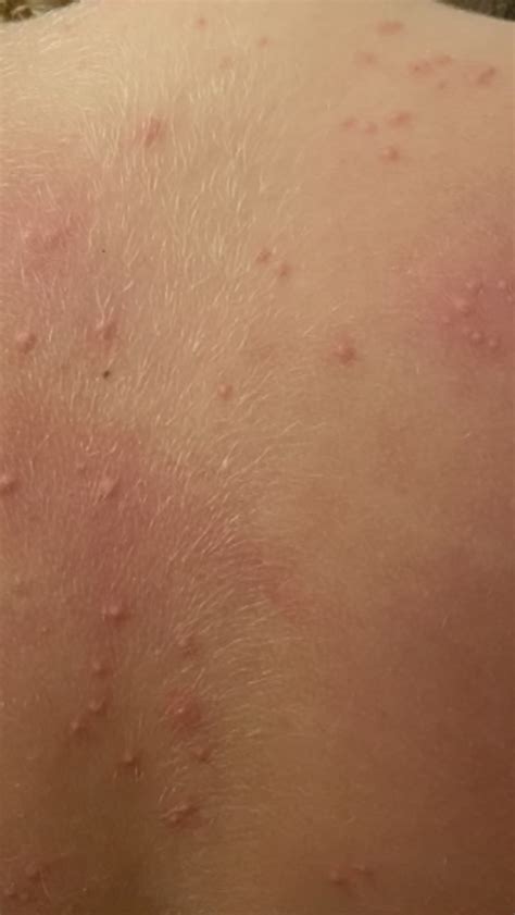 Sea Lice Rash