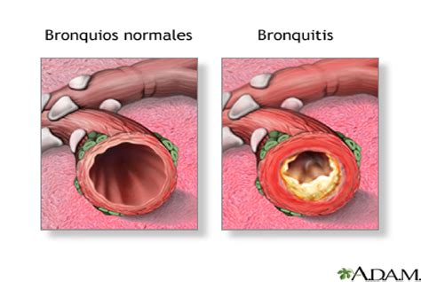 Enfermedades pulmonares : mayo 2015