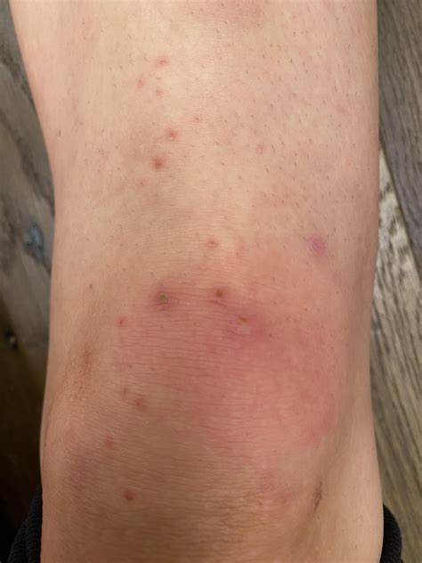 Pimples and swelling on knee? [Misc] : r/SkincareAddiction