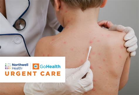 Chickenpox: Symptoms, Treatment, And Vaccination Information | The Well ...