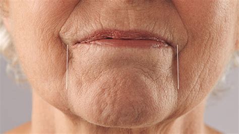 Marionette Lines | Swindon Aesthetic Beauty Treatments