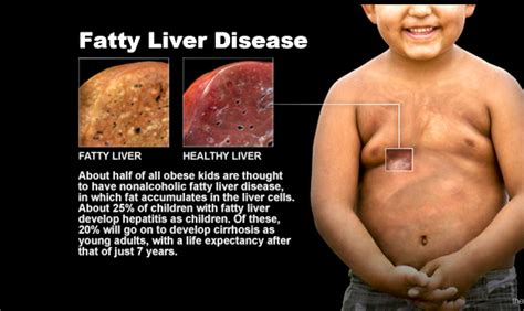 Fatty Liver Disease Symptoms In Kids - Infoupdate.org
