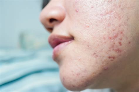 Cystic Acne Chin Scars