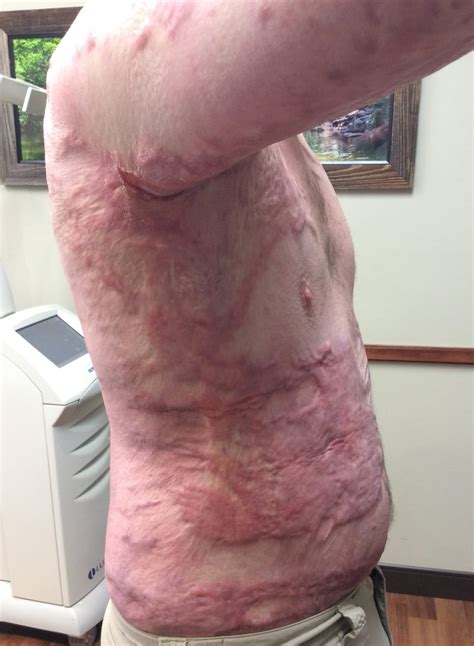 Laser Surgery Burn & Post Operative Scars Dermatologists DR. Hawley